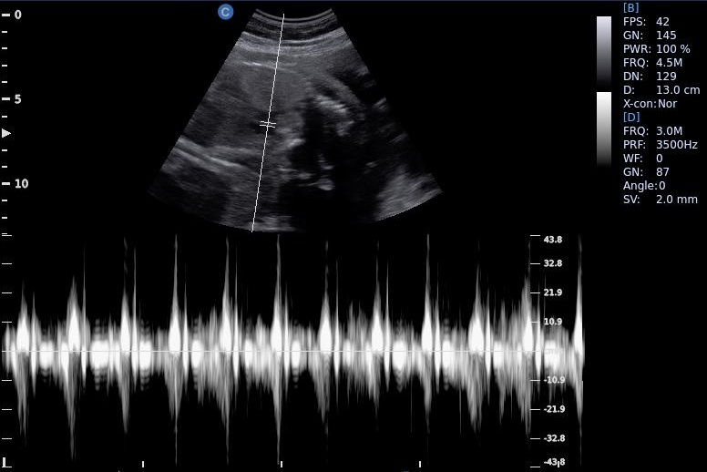 USG Doppler